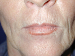 Lines and Wrinkles on the Upper Lip and Around the Mouth Explained – Caci