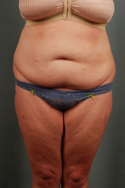 Patient #5874 Tummy Tuck (Abdominoplasty) Plus Size Before and