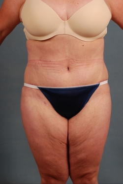 Patient #5874 Tummy Tuck (Abdominoplasty) Plus Size Before and