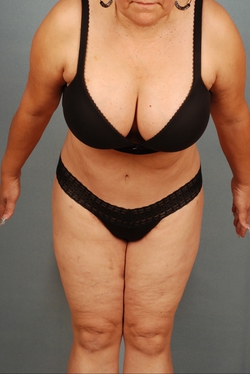 Plus Size Tummy Tuck ®: A Paradigm Shift, Blog