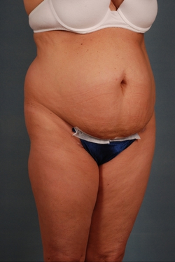 Patient #5874 Tummy Tuck (Abdominoplasty) Plus Size Before and