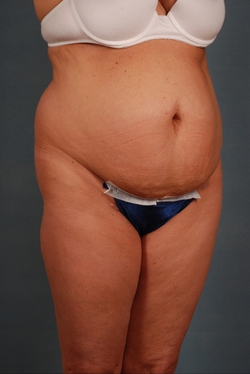 Plus Size Tummy Tuck ®: A Paradigm Shift, Blog